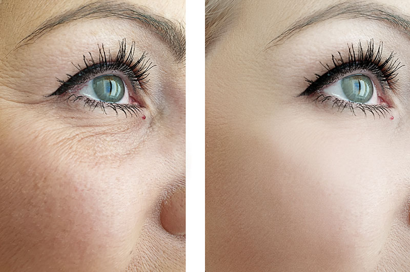 Five Signs It’s Time For Eye Rejuvenation