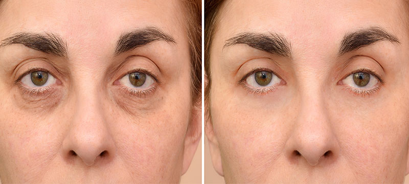 Can an Eyelid Lift Remove Eye Bags?