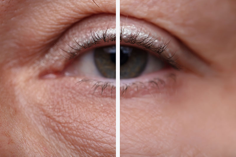 How Long Will Eyelid Lift Scars Take To Heal?