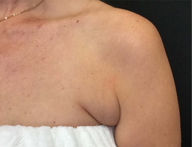 IPL and armpit fat removal