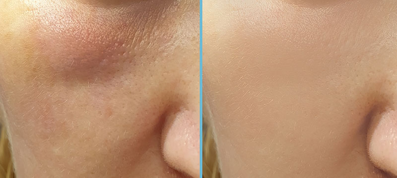 How Long Should Swelling Last After FaceTite™ Treatment?