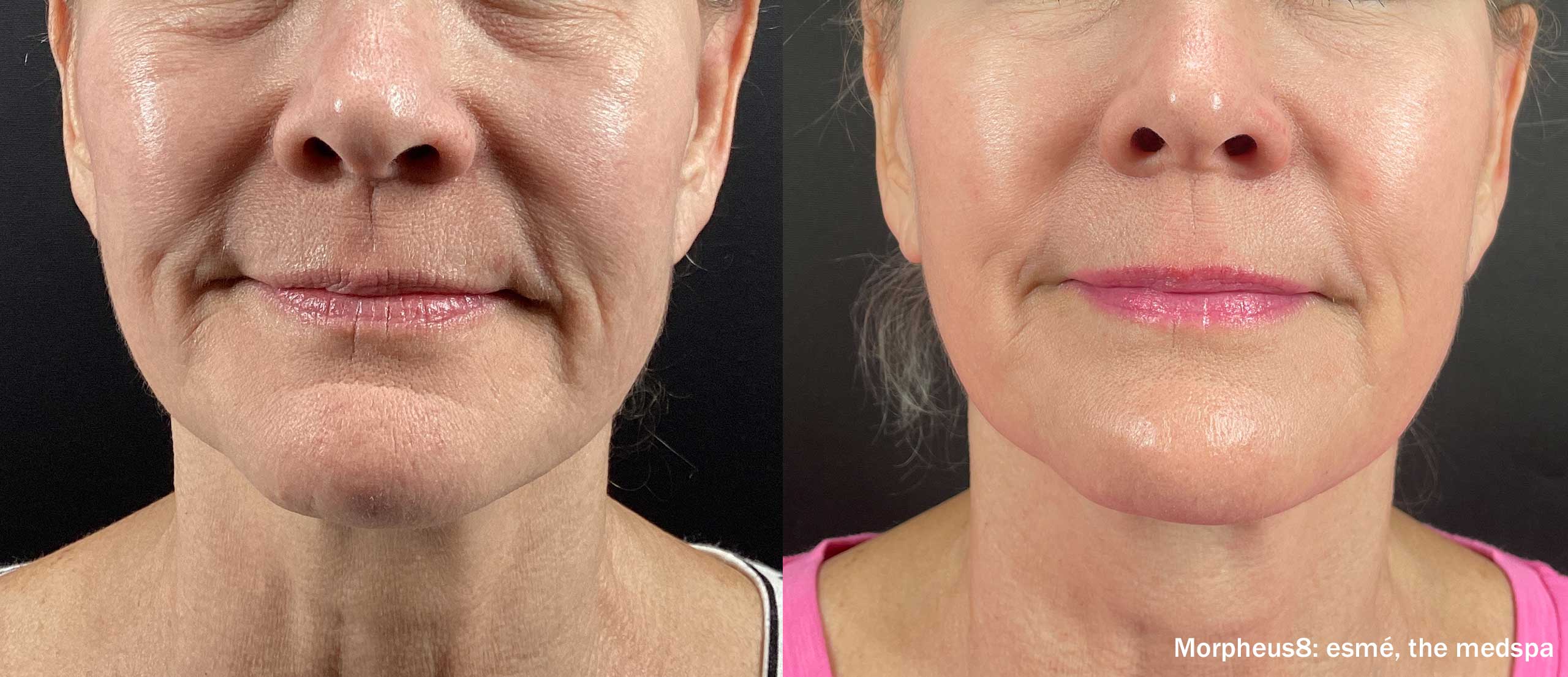 EsmeMedspa Morpheus8 Before After 4Treatments Front TM