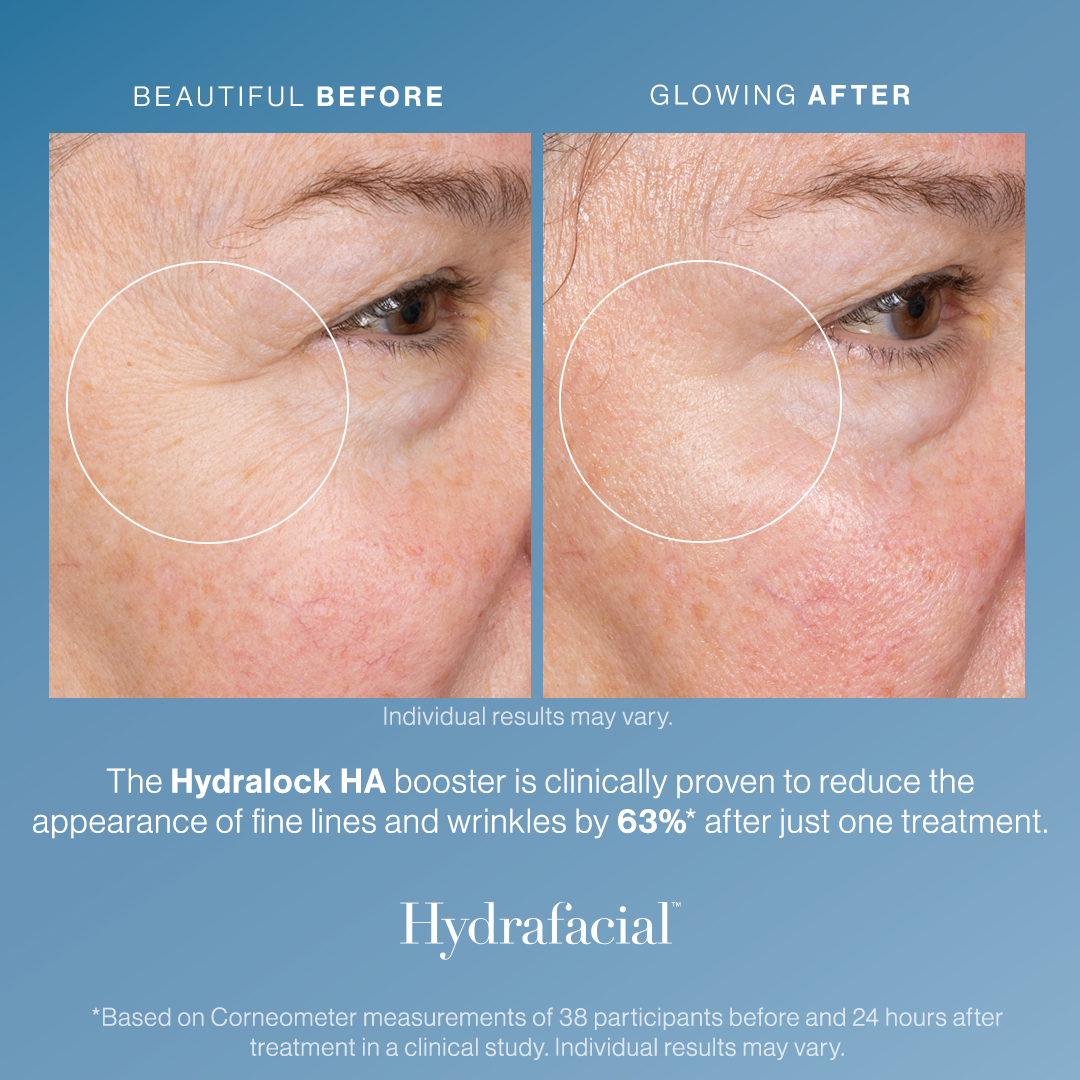 HYDRALOCK BEFORE AFTER 2