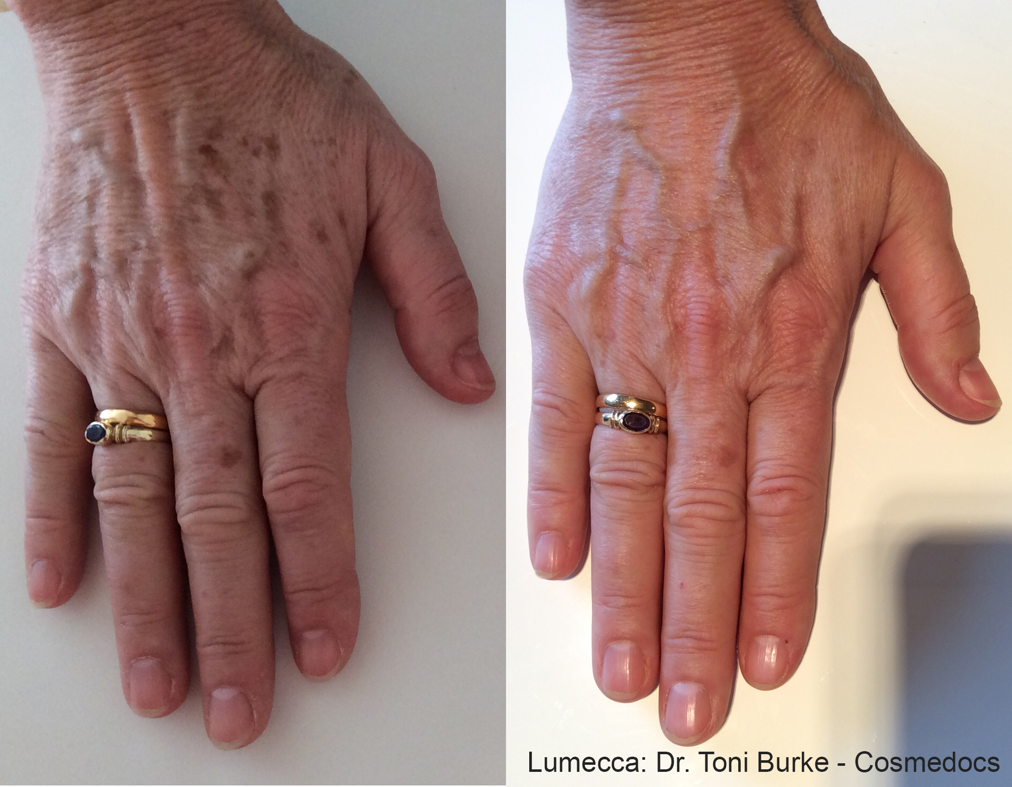 LUMECCA BEFORE AFTER DR TONI BURKE COSMEDOCS PREVIEW 2