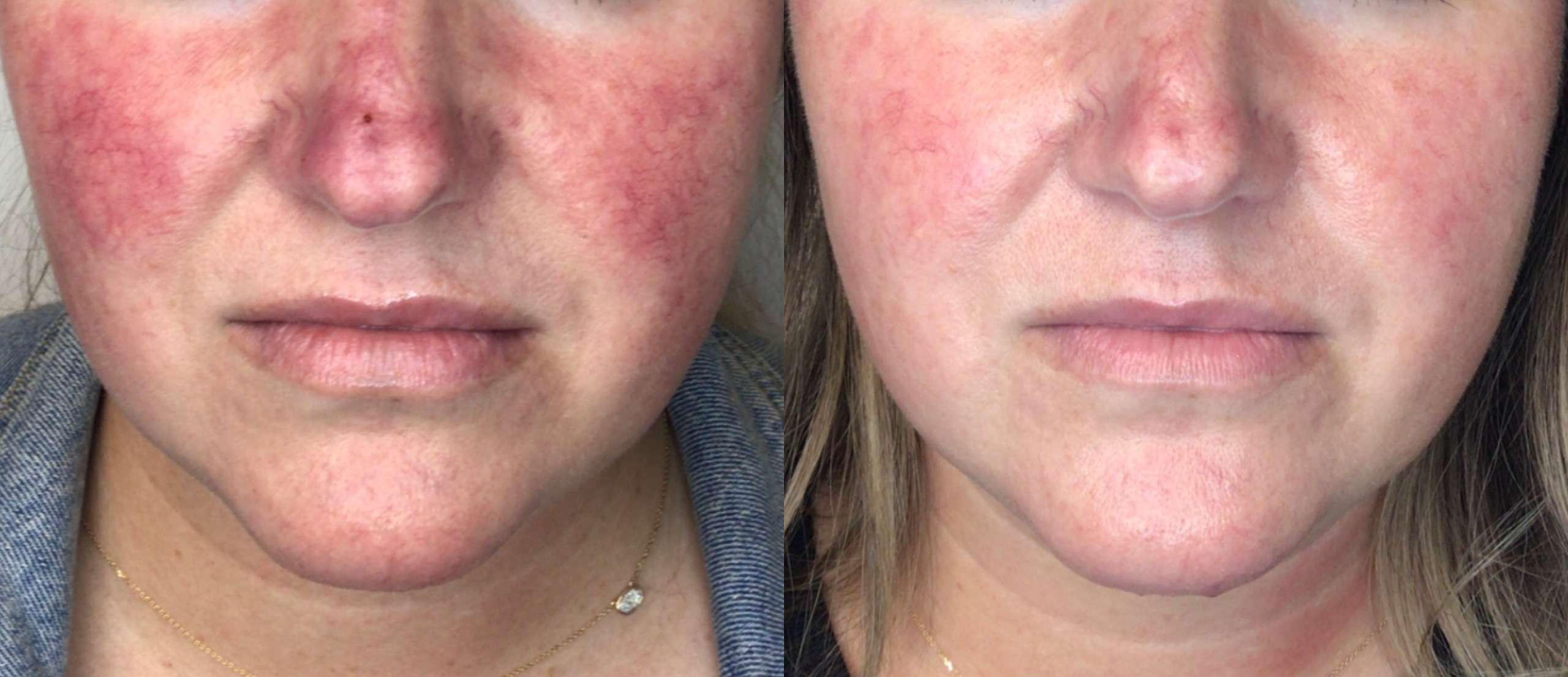 LUMECCA BEFORE AFTER SPRY SKIN AND WELLNESS PREVIEW 1